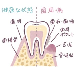 「歯周病はこんな病気。手遅れになる前に予防を。」歯と歯茎の間に汚れが溜まると細菌が増え、歯茎が腫れたり血が出たりする。さらに進行すると歯周ポケットの奥に入り込み、歯槽骨を溶かしてグラグラさせたり（骨吸収）、歯肉を下げて歯が抜け落ちてしまったりする。