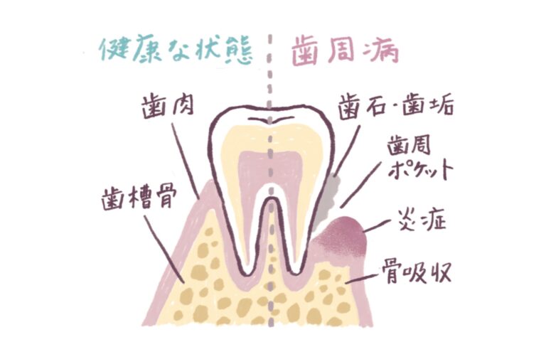 「歯周病はこんな病気。手遅れになる前に予防を。」歯と歯茎の間に汚れが溜まると細菌が増え、歯茎が腫れたり血が出たりする。さらに進行すると歯周ポケットの奥に入り込み、歯槽骨を溶かしてグラグラさせたり（骨吸収）、歯肉を下げて歯が抜け落ちてしまったりする。
