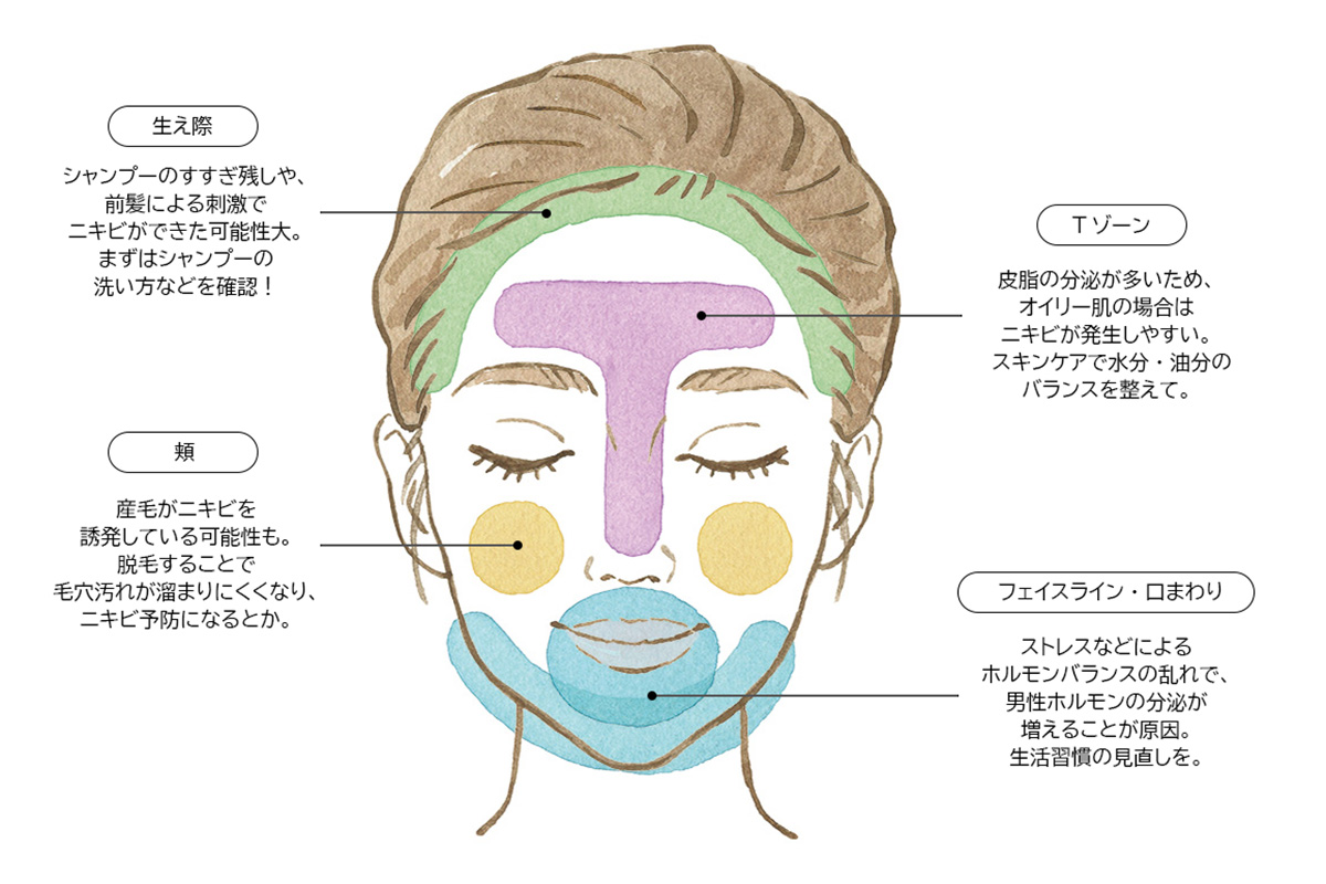 できる場所で解説!ニキビの原因&対処法